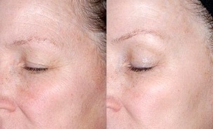 odos atnaujinimas aplink akis prieš ir po nuotraukų